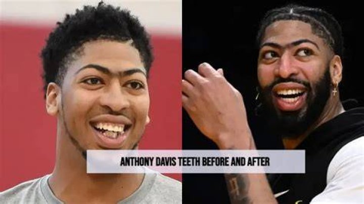 Anthony Davis' Teeth Then And Now
